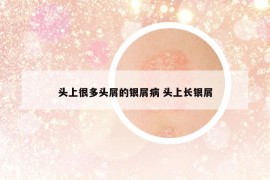 头上很多头屑的银屑病 头上长银屑