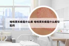 咯吱窝长癣是什么癣 咯吱窝长癣是什么癣引起的