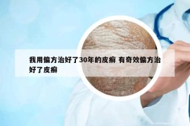 我用偏方治好了30年的皮癣 有奇效偏方治好了皮癣