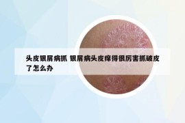 头皮银屑病抓 银屑病头皮痒得很厉害抓破皮了怎么办