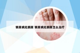 银屑病无麟屑 银屑病无麟屑怎么治疗