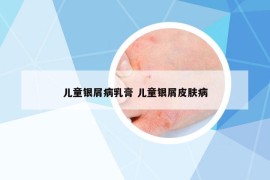 儿童银屑病乳膏 儿童银屑皮肤病