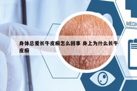 身体总爱长牛皮癣怎么回事 身上为什么长牛皮癣