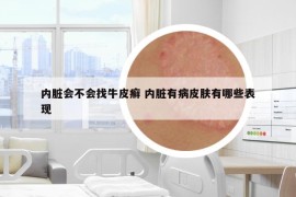内脏会不会找牛皮癣 内脏有病皮肤有哪些表现