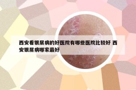 西安看银屑病的好医院有哪些医院比较好 西安银屑病哪家最好