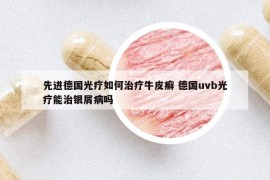 先进德国光疗如何治疗牛皮癣 德国uvb光疗能治银屑病吗