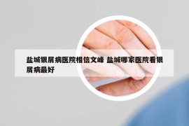 盐城银屑病医院相信文峰 盐城哪家医院看银屑病最好