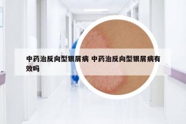 中药治反向型银屑病 中药治反向型银屑病有效吗