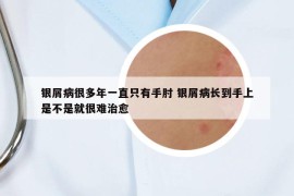 银屑病很多年一直只有手肘 银屑病长到手上是不是就很难治愈
