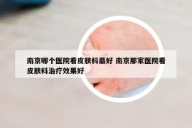 南京哪个医院看皮肤科最好 南京那家医院看皮肤科治疗效果好