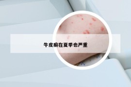 牛皮癣在夏季也严重
