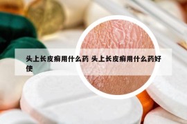 头上长皮癣用什么药 头上长皮癣用什么药好使