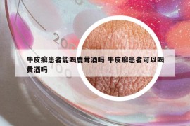 牛皮癣患者能喝鹿茸酒吗 牛皮癣患者可以喝黄酒吗