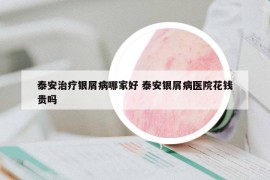 泰安治疗银屑病哪家好 泰安银屑病医院花钱贵吗