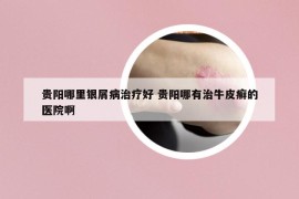 贵阳哪里银屑病治疗好 贵阳哪有治牛皮癣的医院啊