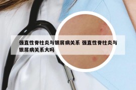 强直性脊柱炎与银屑病关系 强直性脊柱炎与银屑病关系大吗