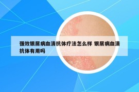 强效银屑病血清抗体疗法怎么样 银屑病血清抗体有用吗