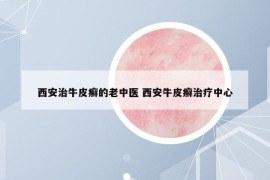 西安治牛皮癣的老中医 西安牛皮癣治疗中心