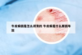 牛皮癣因是怎么诱发的 牛皮癣是什么原因导致