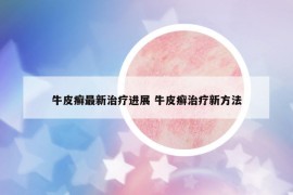 牛皮癣最新治疗进展 牛皮癣治疗新方法