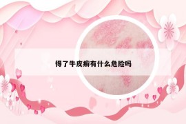 得了牛皮癣有什么危险吗