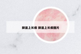 脚面上长癣 脚面上长癣图片