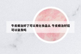 牛皮癣治好了可以用化妆品么 牛皮癣治好后可以染发吗