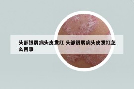 头部银屑病头皮发红 头部银屑病头皮发红怎么回事