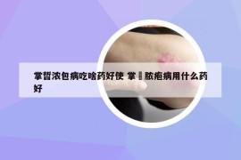 掌哲浓包病吃啥药好使 掌踀脓疱病用什么药好
