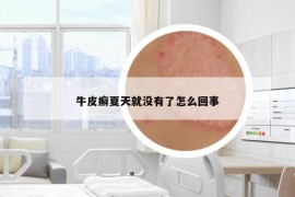 牛皮癣夏天就没有了怎么回事