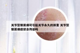 关节型银屑病可引起关节永久的损害 关节型银屑病症状会传染吗