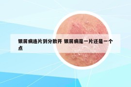 银屑病连片到分散开 银屑病是一片还是一个点
