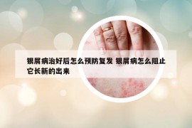 银屑病治好后怎么预防复发 银屑病怎么阻止它长新的出来