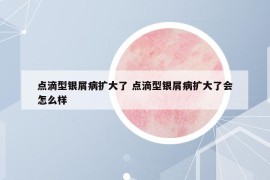点滴型银屑病扩大了 点滴型银屑病扩大了会怎么样