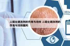 二硫化硒洗剂的作用与功效 二硫化硒洗剂的作用与功效图片