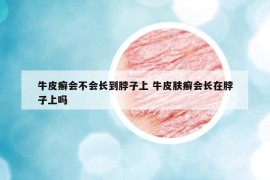 牛皮癣会不会长到脖子上 牛皮肤癣会长在脖子上吗