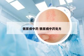银屑病中药 银屑病中药处方