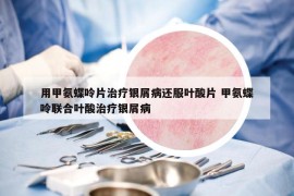 用甲氨蝶呤片治疗银屑病还服叶酸片 甲氨蝶呤联合叶酸治疗银屑病