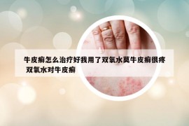 牛皮癣怎么治疗好我用了双氧水莫牛皮癣很疼 双氧水对牛皮癣