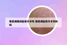 银屑病期间能做手术吗 银屑病能做手术切除吗