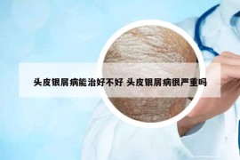 头皮银屑病能治好不好 头皮银屑病很严重吗
