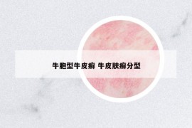 牛胞型牛皮癣 牛皮肤癣分型