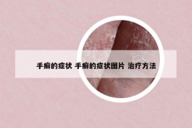 手癣的症状 手癣的症状图片 治疗方法