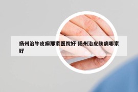 扬州治牛皮癣那家医院好 扬州治皮肤病哪家好