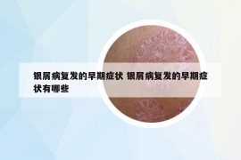 银屑病复发的早期症状 银屑病复发的早期症状有哪些