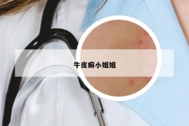 牛皮癣小姐姐