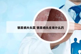 银屑病大头菜 银屑病头皮用什么药