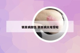 银屑病胆怯 银屑病太难受啦