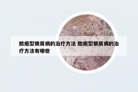 脓疱型银屑病的治疗方法 脓疱型银屑病的治疗方法有哪些