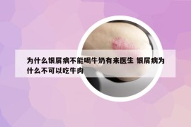 为什么银屑病不能喝牛奶有来医生 银屑病为什么不可以吃牛肉